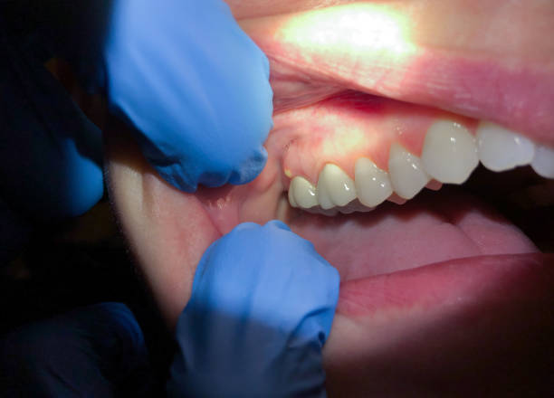 Best Emergency Gum Treatment in USA